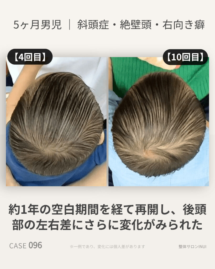 生後5ヶ月男児の斜頭症ビフォーアフター比較
