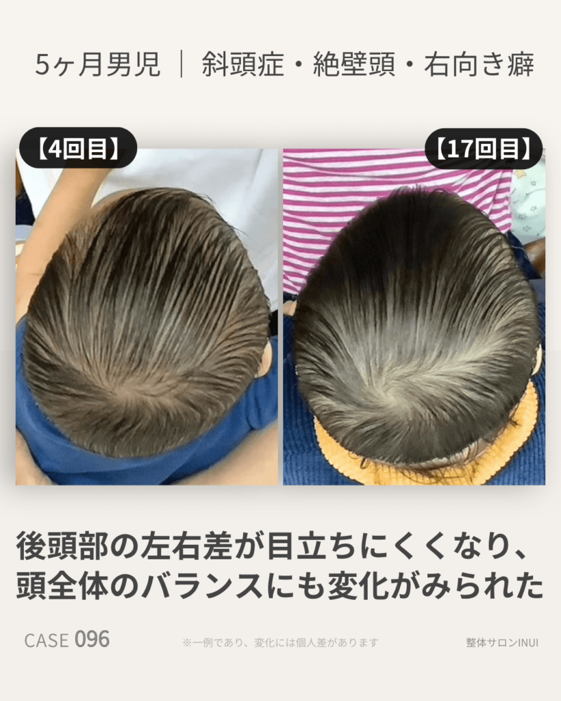 生後5ヶ月男児の斜頭症ビフォーアフター比較