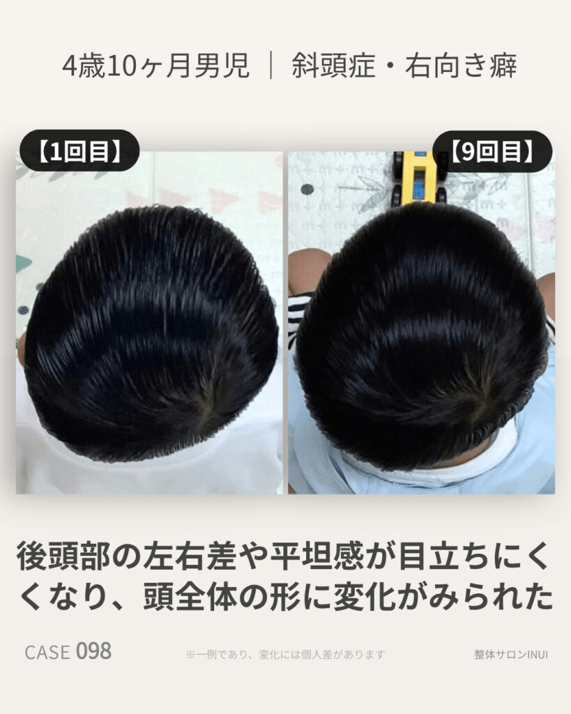 4歳10ヶ月男児の斜頭症ビフォーアフター比較