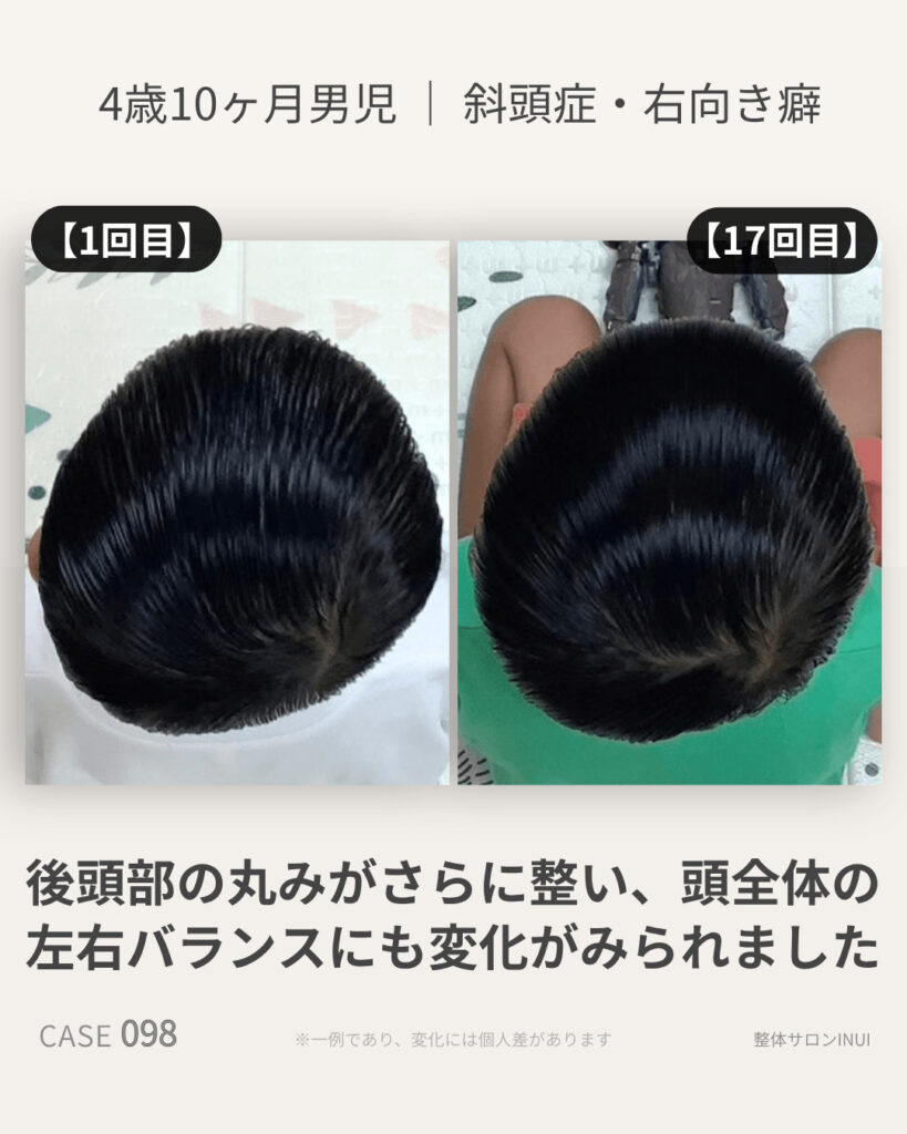 4歳10ヶ月男児の斜頭症ビフォーアフター比較