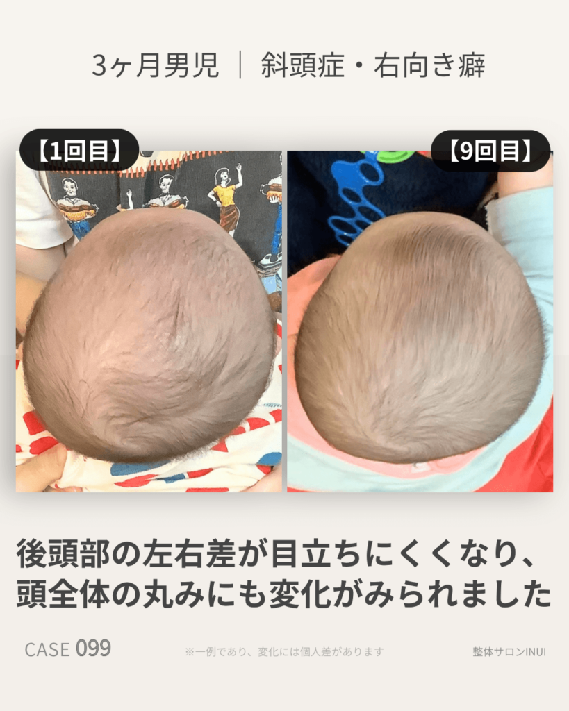 生後3ヶ月男児の斜頭症ビフォーアフター比較