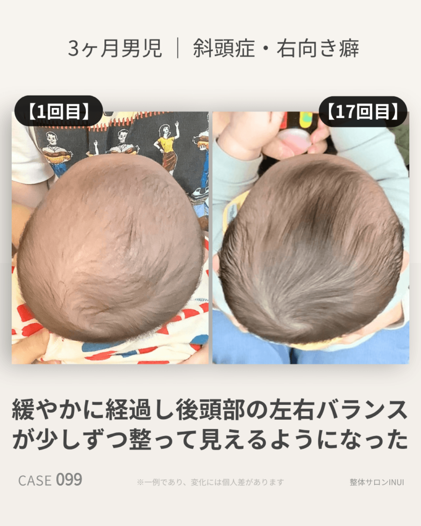 生後3ヶ月男児の斜頭症ビフォーアフター比較