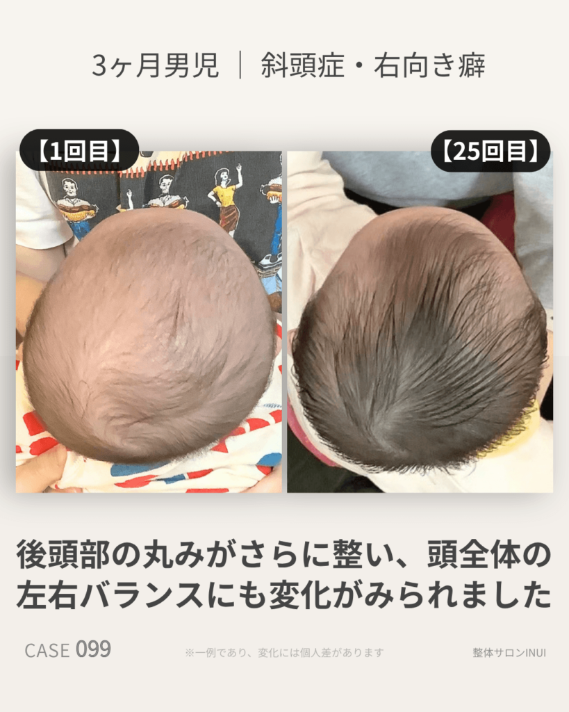 生後3ヶ月男児の斜頭症ビフォーアフター比較