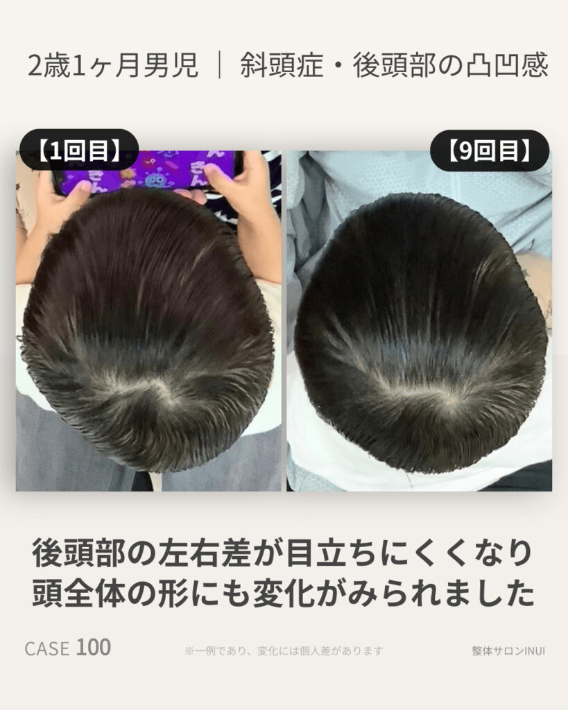 2歳1ヶ月男児の斜頭症ビフォーアフター比較