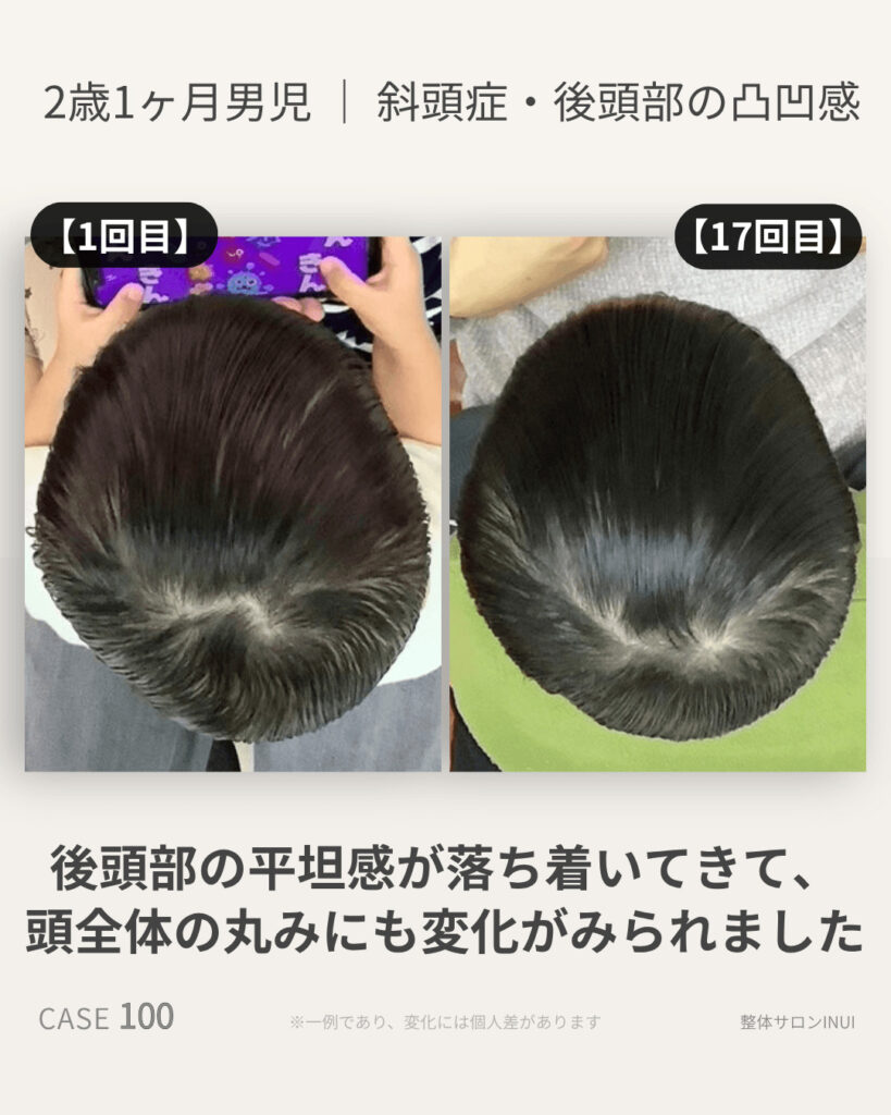2歳1ヶ月男児の斜頭症ビフォーアフター比較
