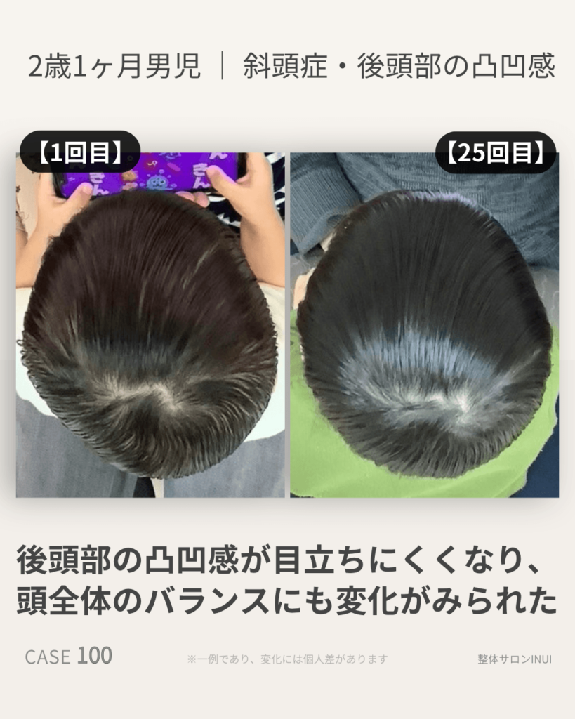 2歳1ヶ月男児の斜頭症ビフォーアフター比較