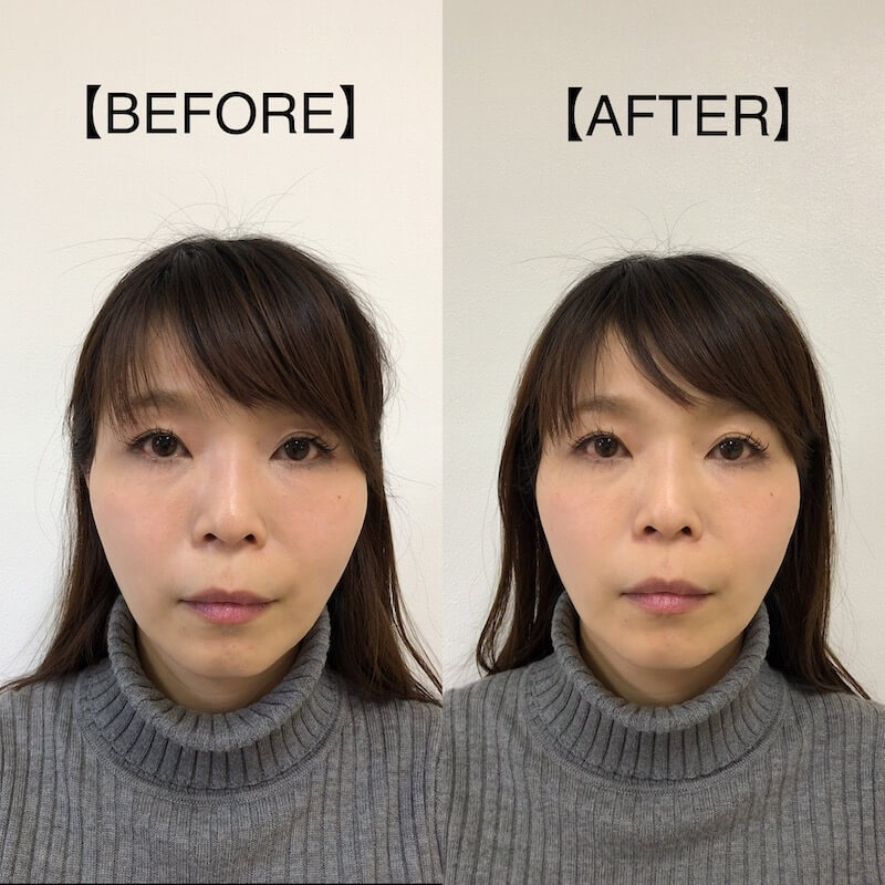 小顔矯正の施術前後の写真