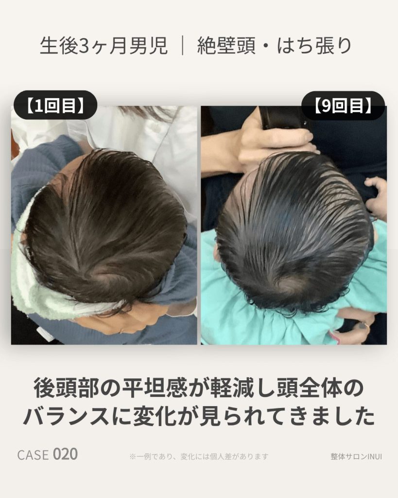 生後3ヶ月男児の絶壁頭ビフォーアフター比較