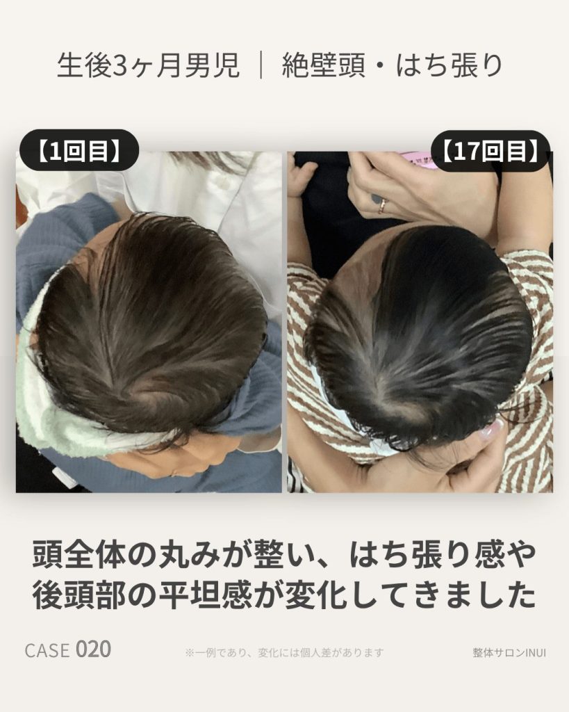 生後3ヶ月男児の絶壁頭ビフォーアフター比較