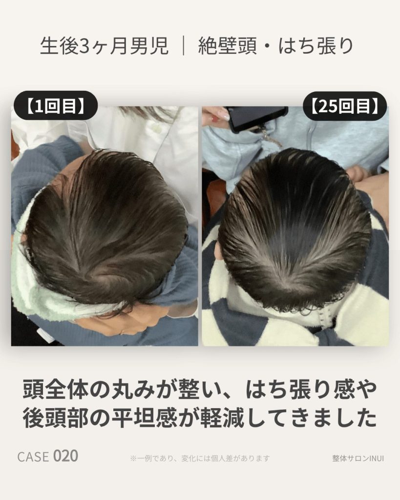 生後3ヶ月男児の絶壁頭ビフォーアフター比較