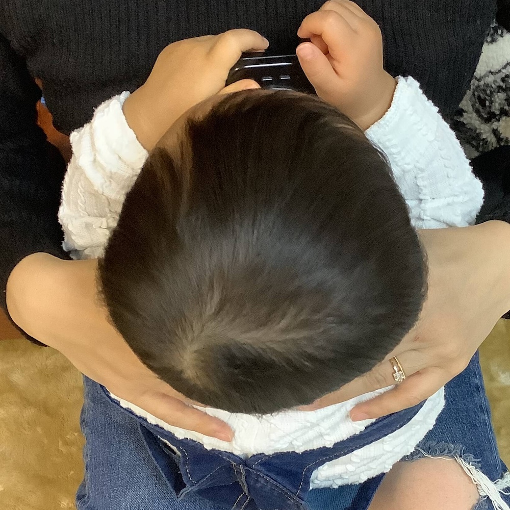 1歳8ヶ月女児の絶壁頭による後頭部の平坦感・はち張り