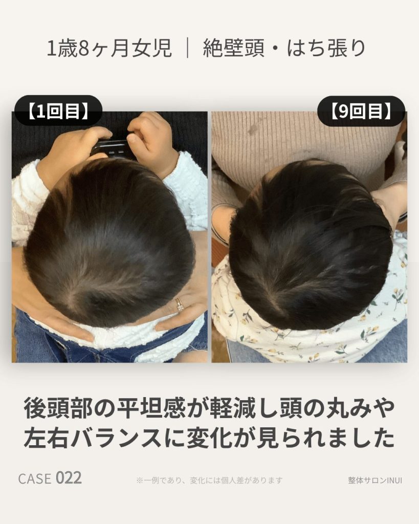 1歳8ヶ月女児の絶壁頭・はち張りビフォーアフター比較
