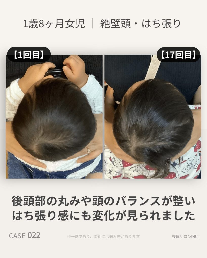1歳8ヶ月女児の絶壁頭・はち張りビフォーアフター比較