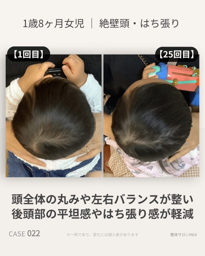 1歳8ヶ月女児の絶壁頭・はち張りビフォーアフター比較
