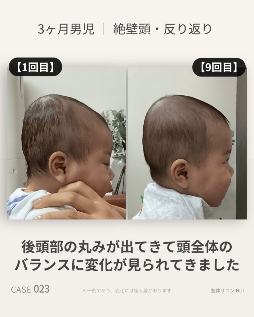 生後3ヶ月男児の絶壁頭ビフォーアフター比較