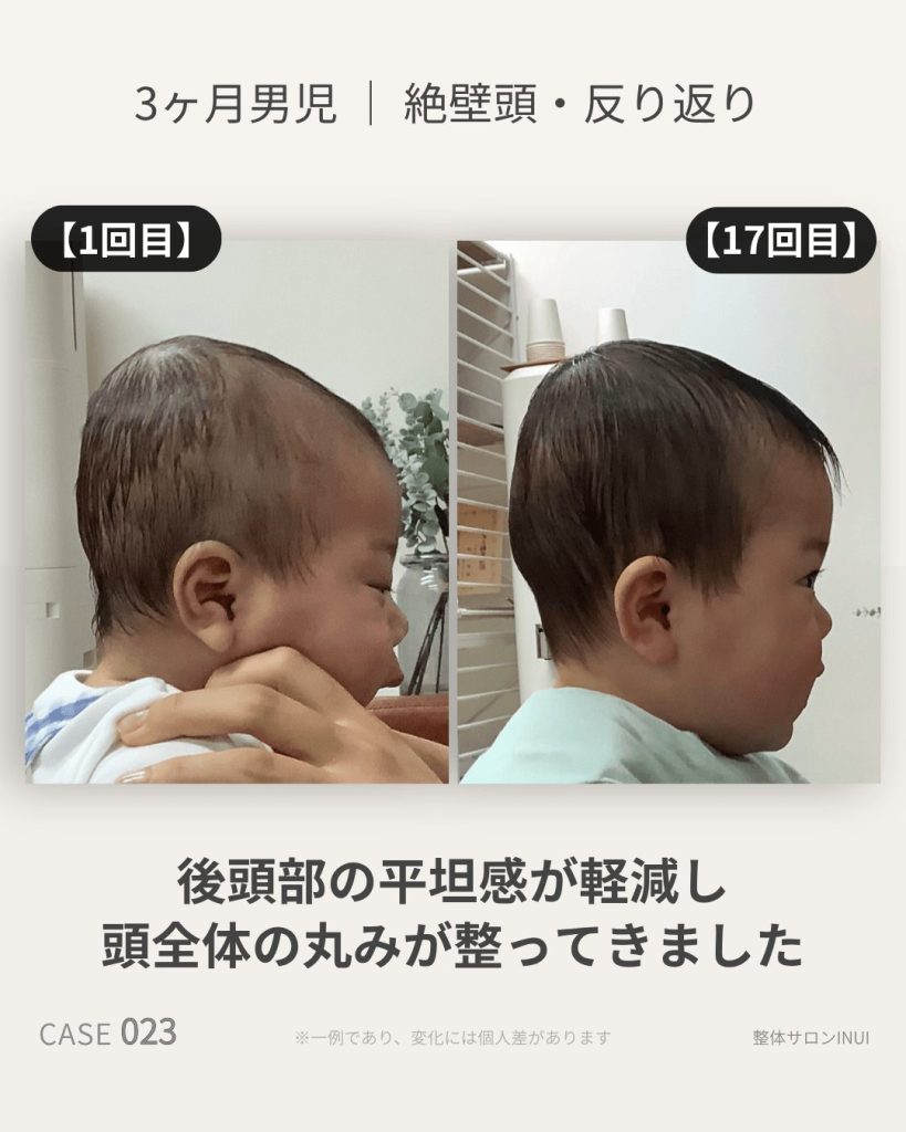 生後3ヶ月男児の絶壁頭ビフォーアフター比較
