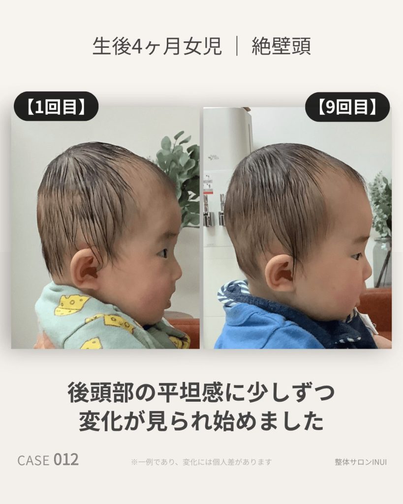 生後4ヶ月女児の絶壁頭ビフォーアフター比較