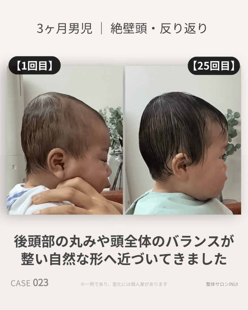 生後3ヶ月男児の絶壁頭ビフォーアフター比較