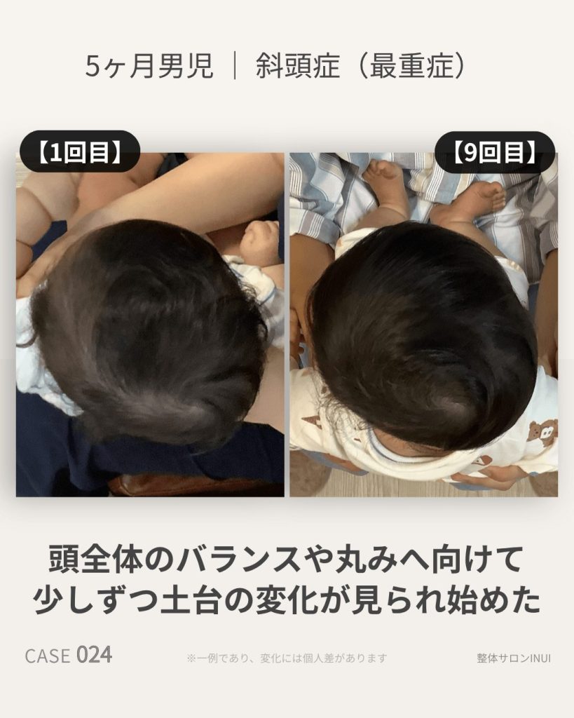 生後5ヶ月男児の斜頭症ビフォーアフター比較