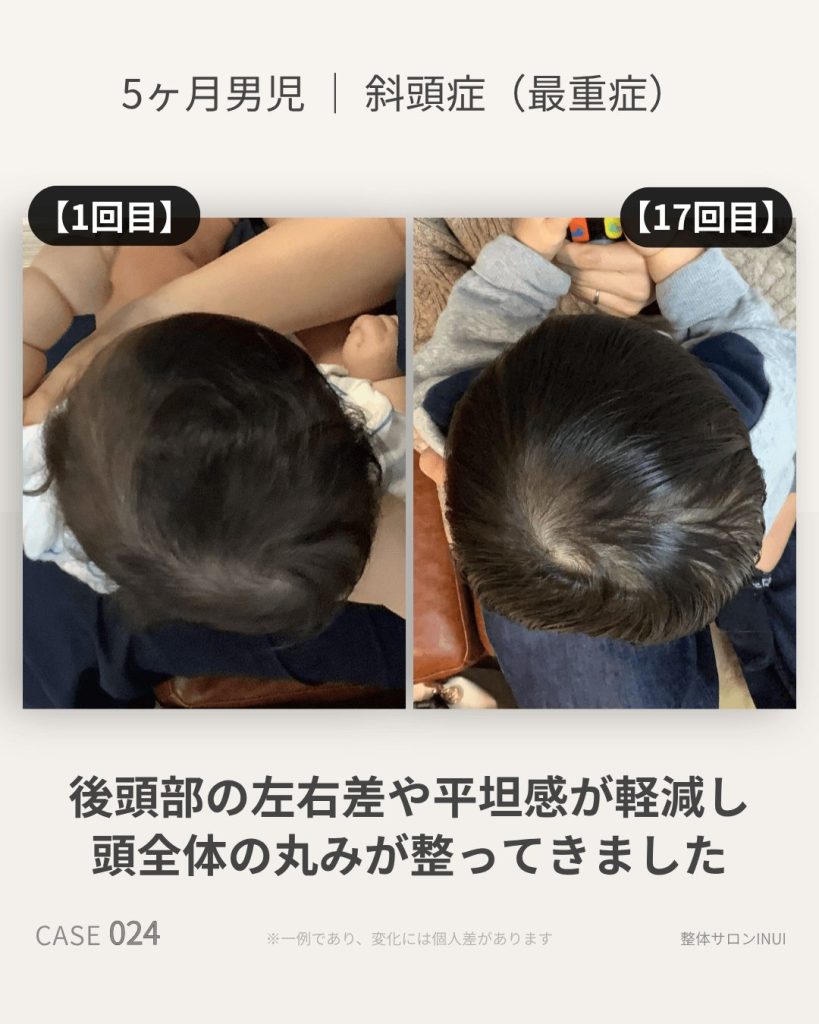 生後5ヶ月男児の斜頭症ビフォーアフター比較