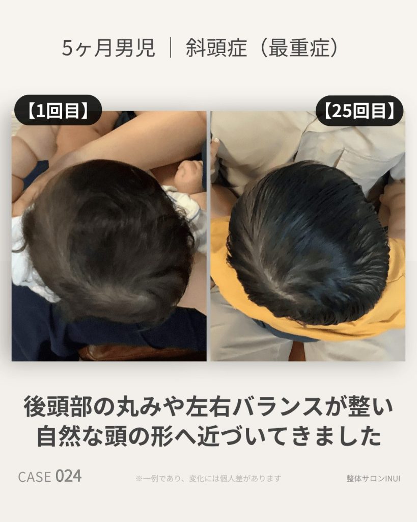 生後5ヶ月男児の斜頭症ビフォーアフター比較