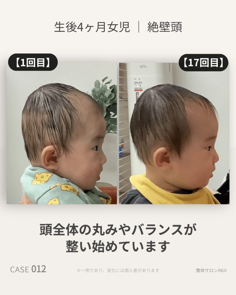 生後4ヶ月女児の絶壁頭ビフォーアフター比較