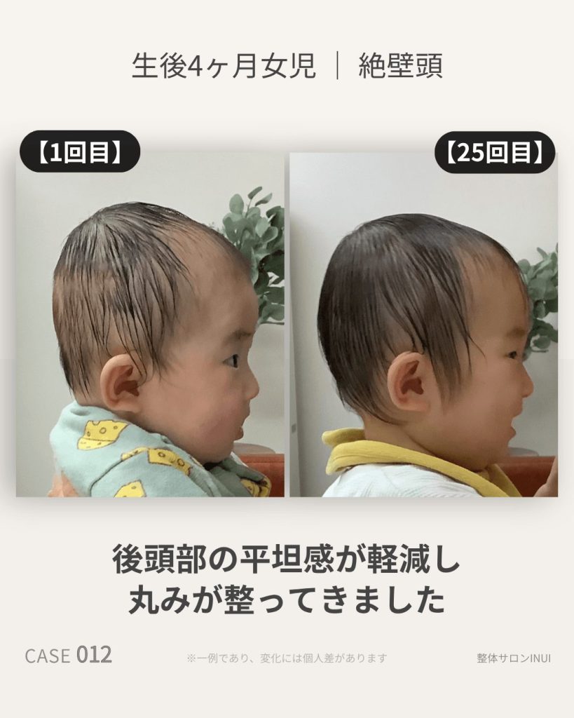 生後4ヶ月女児の絶壁頭ビフォーアフター比較