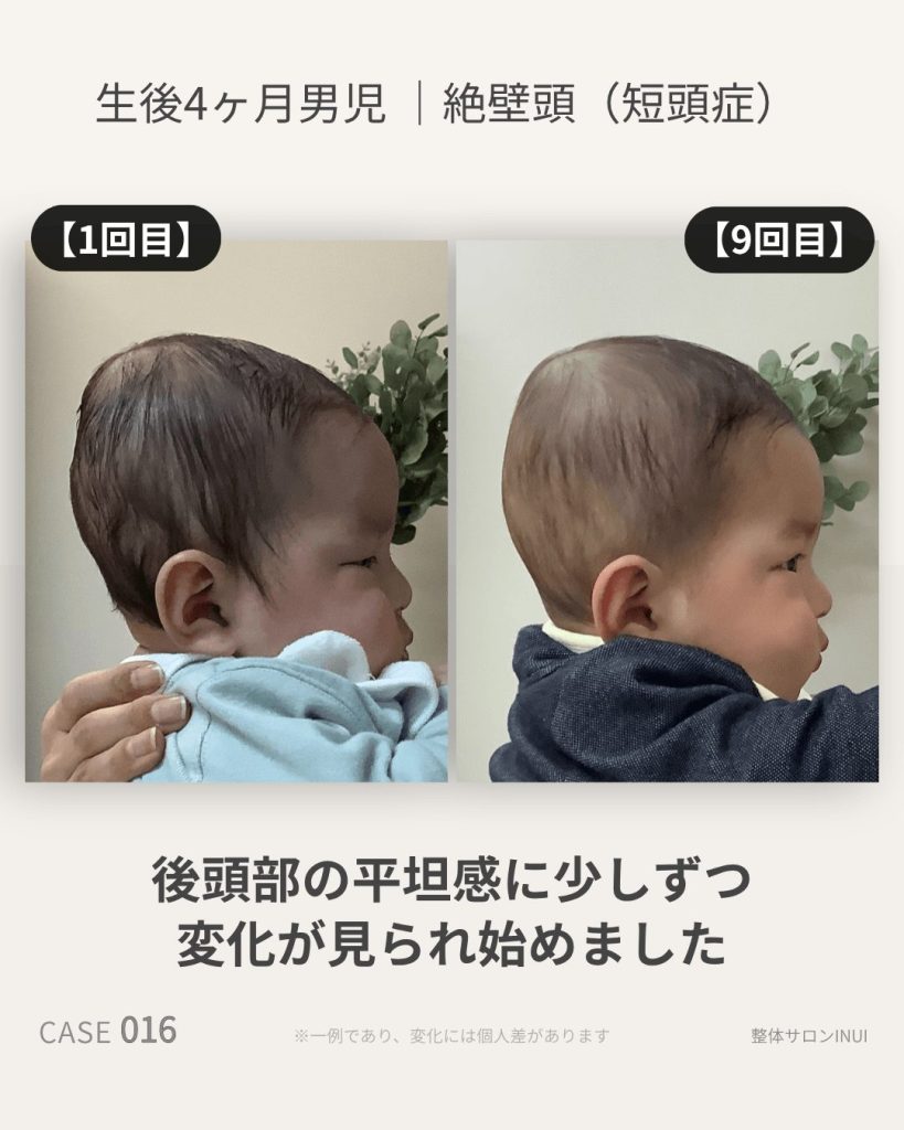 生後4ヶ月男児の絶壁頭ビフォーアフター比較