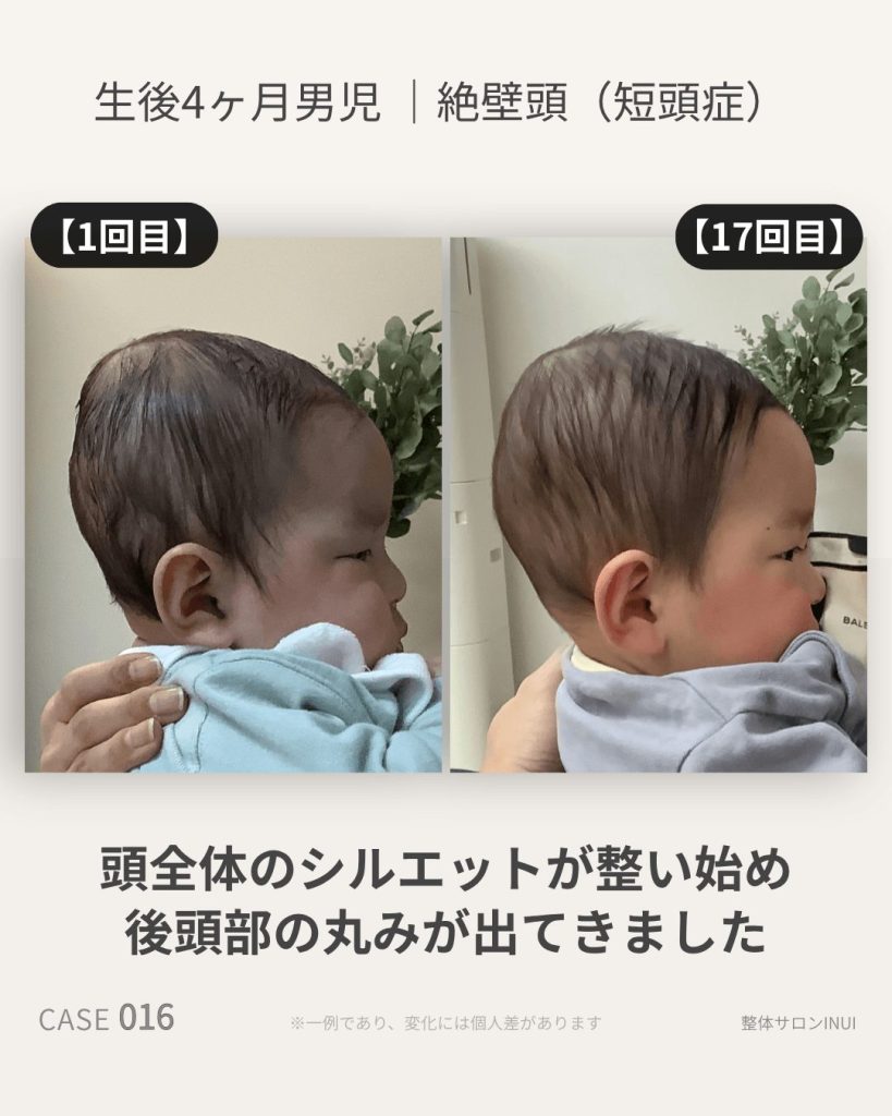 生後4ヶ月男児の絶壁頭ビフォーアフター比較