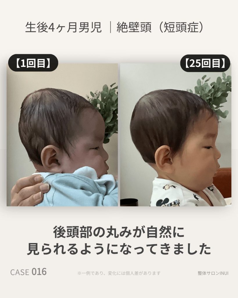 生後4ヶ月男児の絶壁頭ビフォーアフター比較