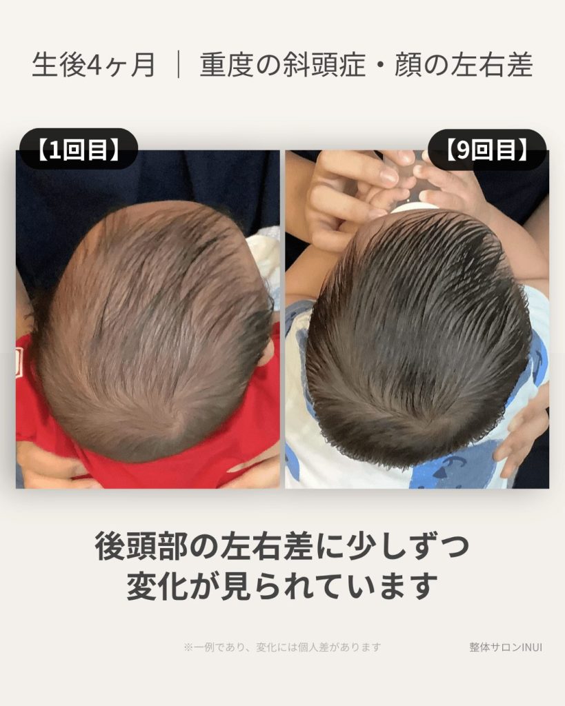 生後4ヶ月男児の斜頭症ビフォーアフター比較