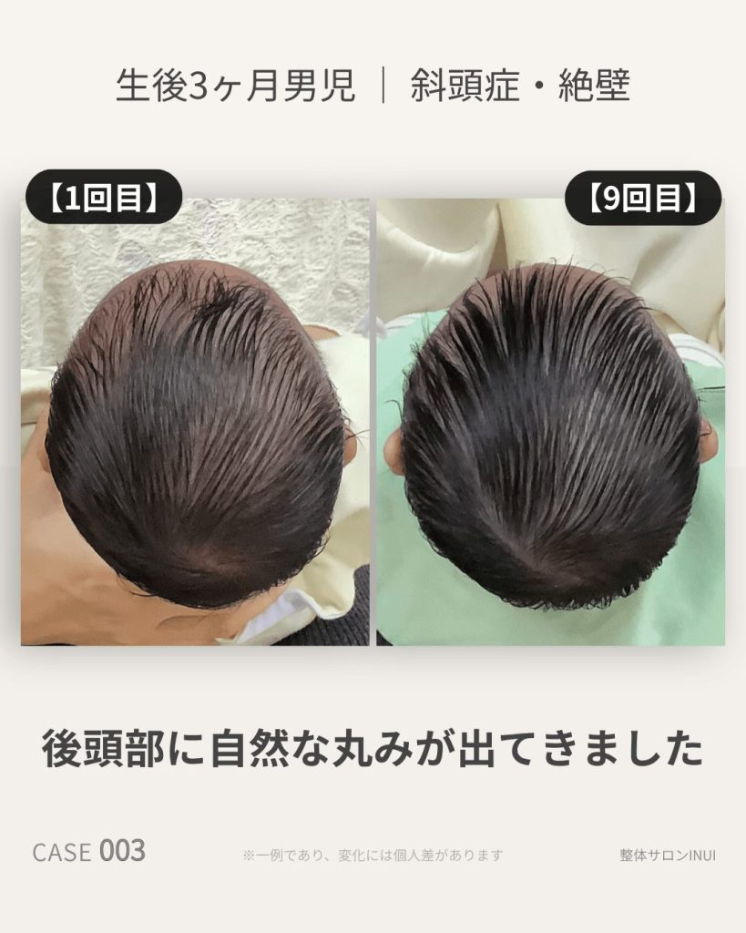 生後3ヶ月男児の斜頭症ビフォーアフター比較