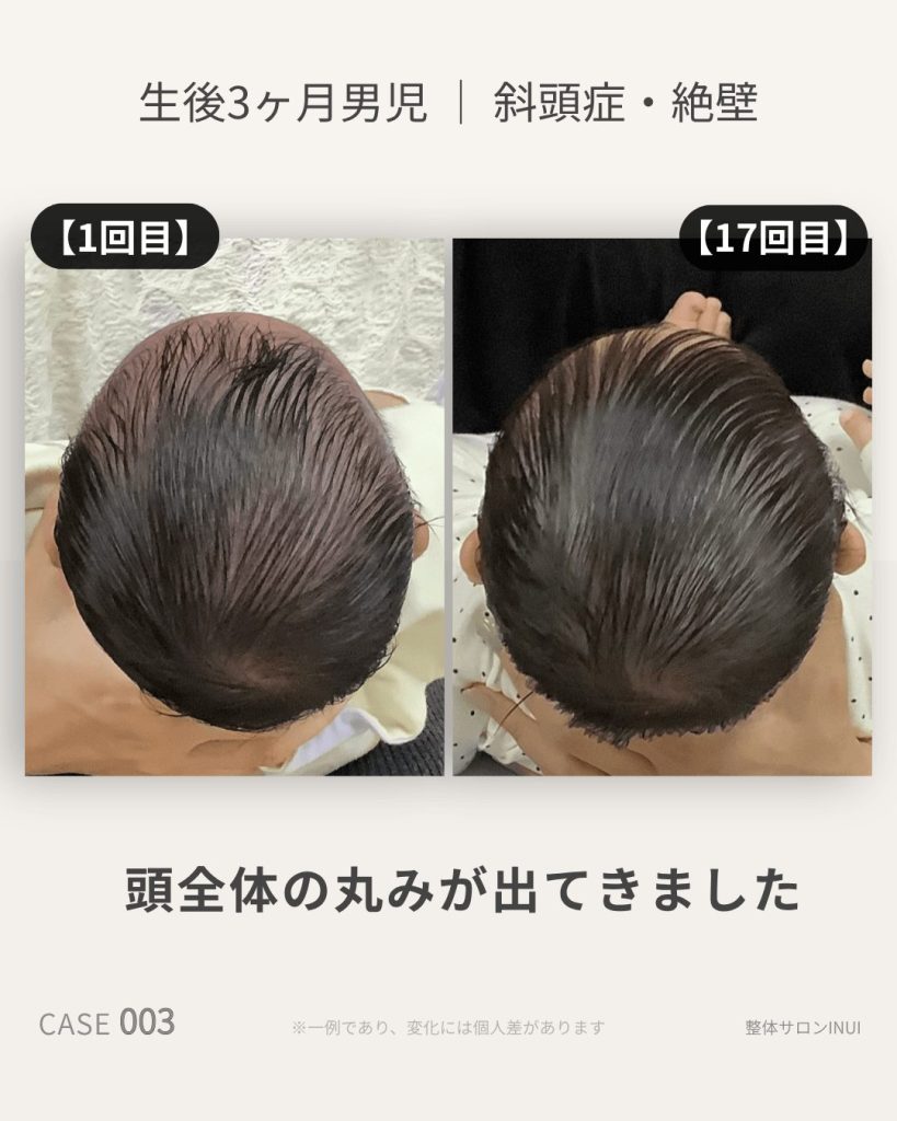 生後3ヶ月男児の斜頭症ビフォーアフター比較