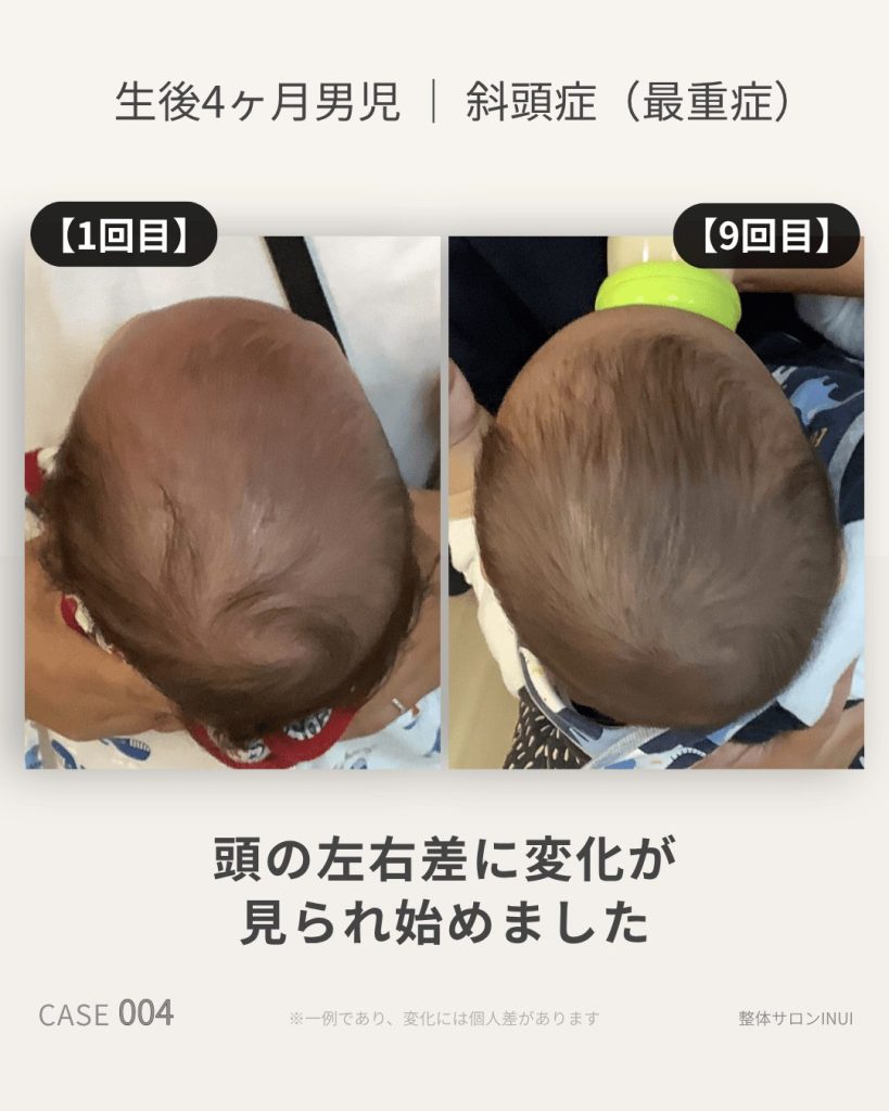 生後4ヶ月男児の斜頭症ビフォーアフター比較