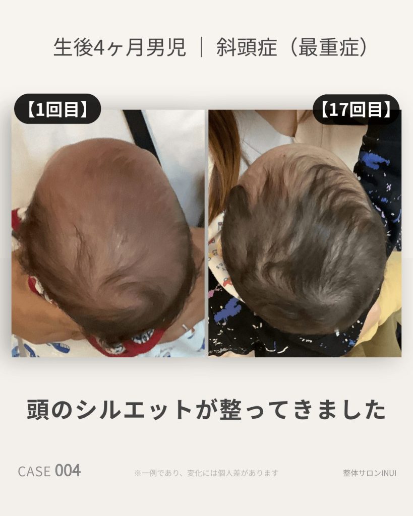 生後4ヶ月男児の斜頭症ビフォーアフター比較