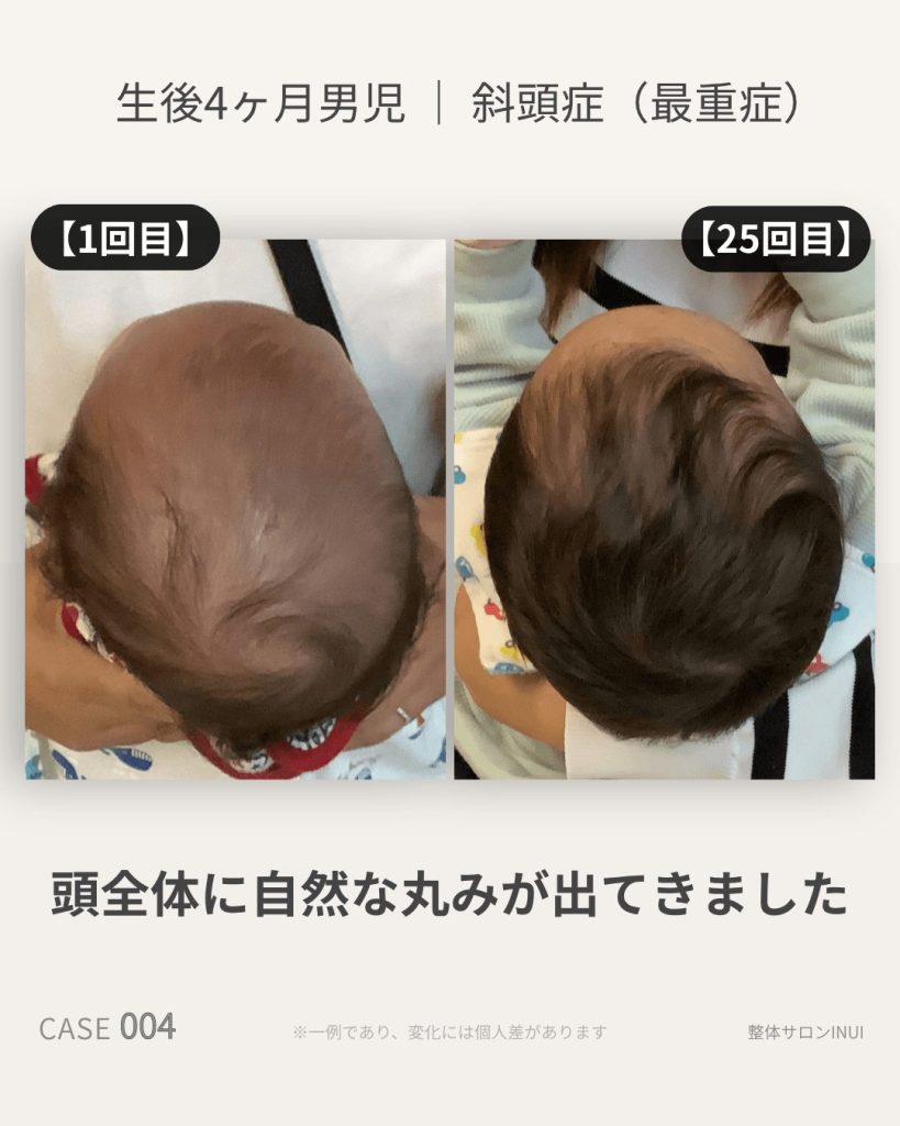 生後4ヶ月男児の斜頭症ビフォーアフター比較