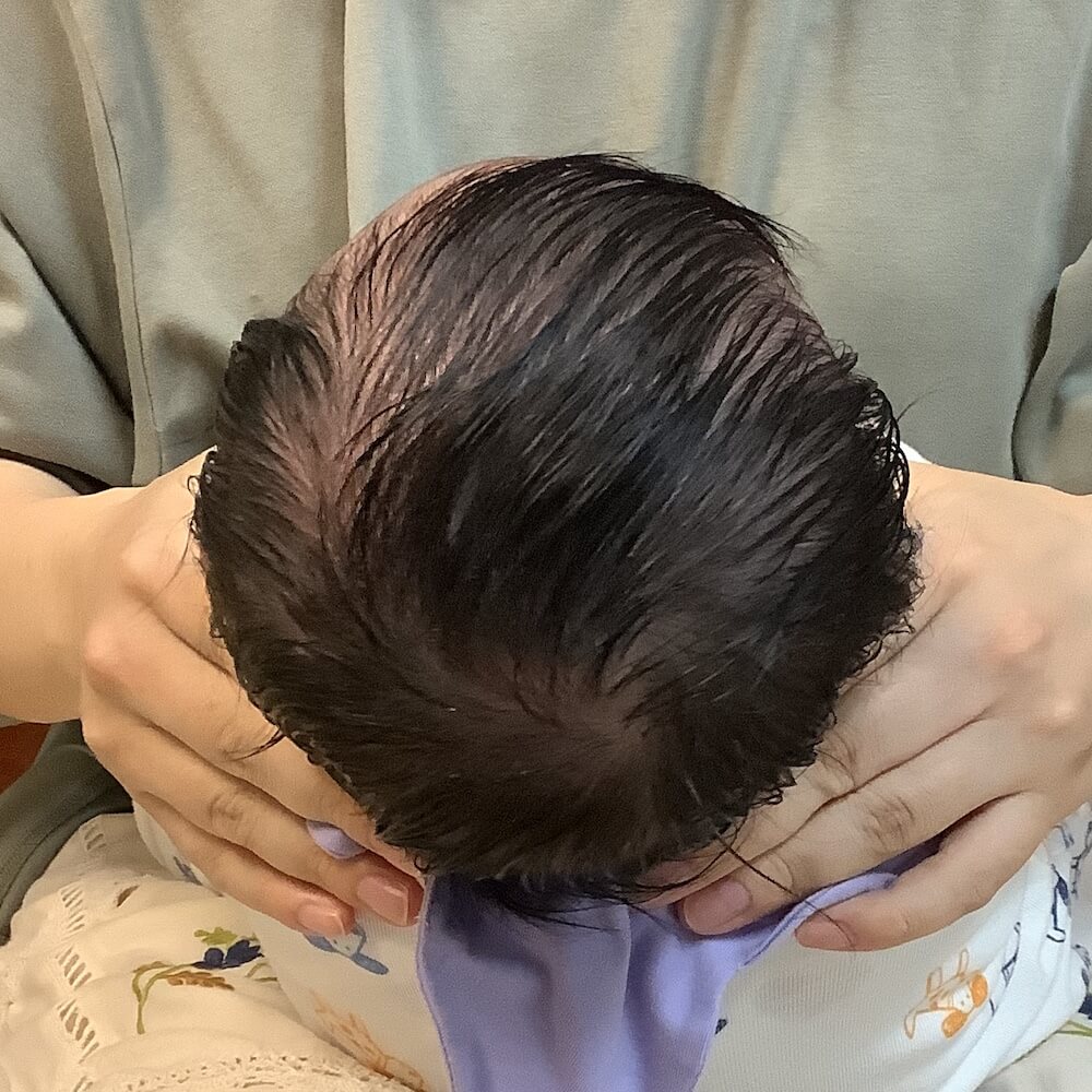 生後3ヶ月男児の斜頭症による後頭部左右差