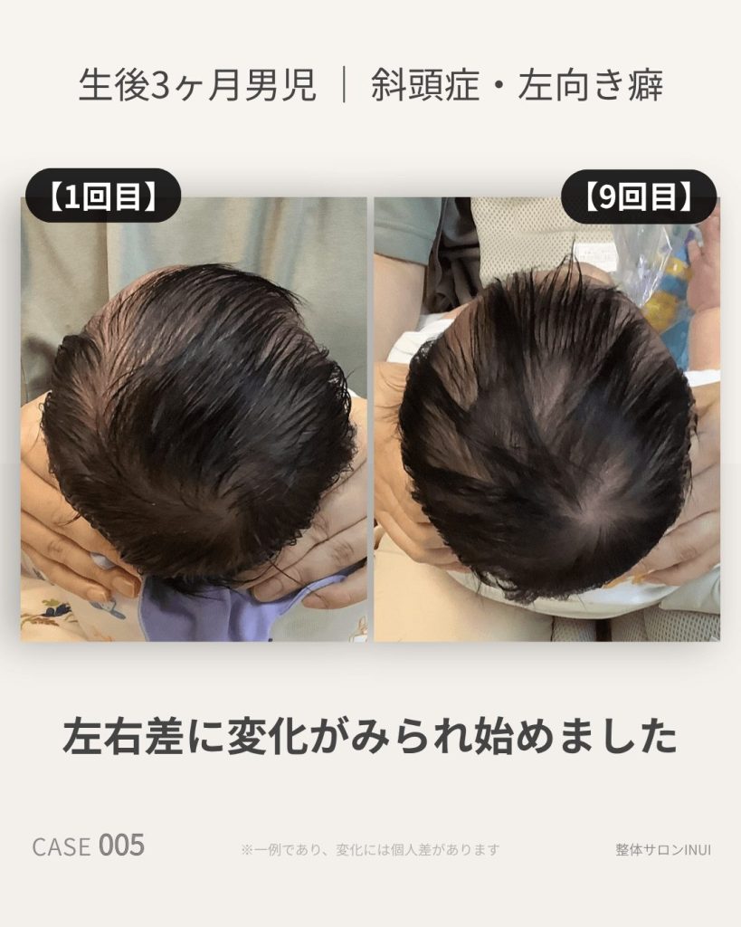 生後3ヶ月男児の斜頭症ビフォーアフター比較