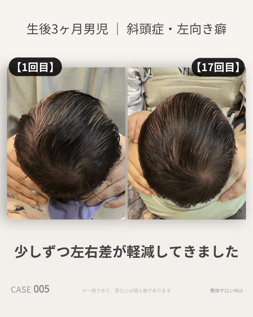 生後3ヶ月男児の斜頭症ビフォーアフター比較