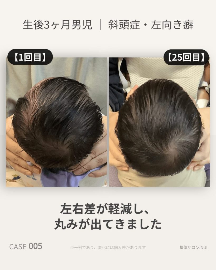 生後3ヶ月男児の斜頭症ビフォーアフター比較