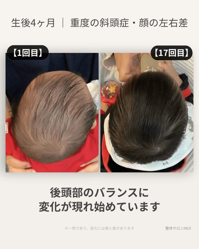 生後4ヶ月男児の斜頭症ビフォーアフター比較