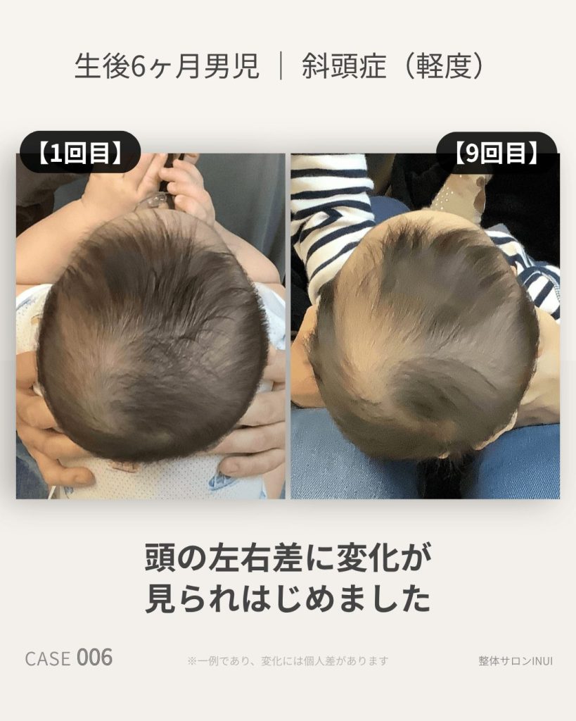 生後6ヶ月男児の斜頭症ビフォーアフター比較