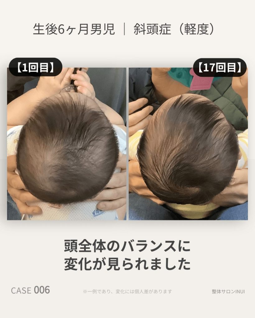 生後6ヶ月男児の斜頭症ビフォーアフター比較