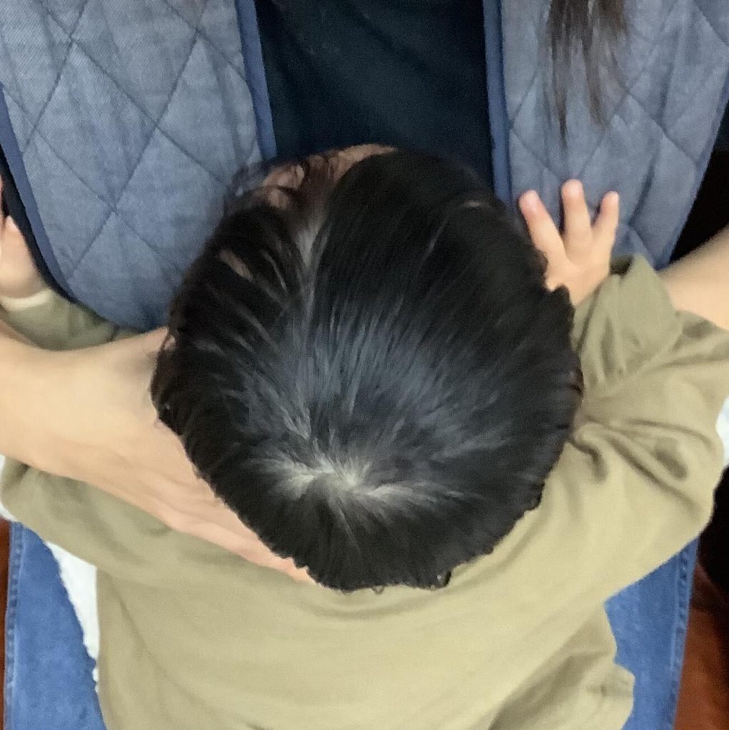 生後8ヶ月女児の斜頭症による後頭部左右差