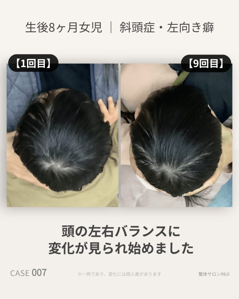 生後8ヶ月女児の斜頭症ビフォーアフター比較