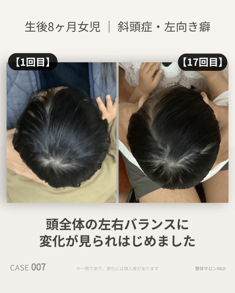 生後8ヶ月女児の斜頭症ビフォーアフター比較