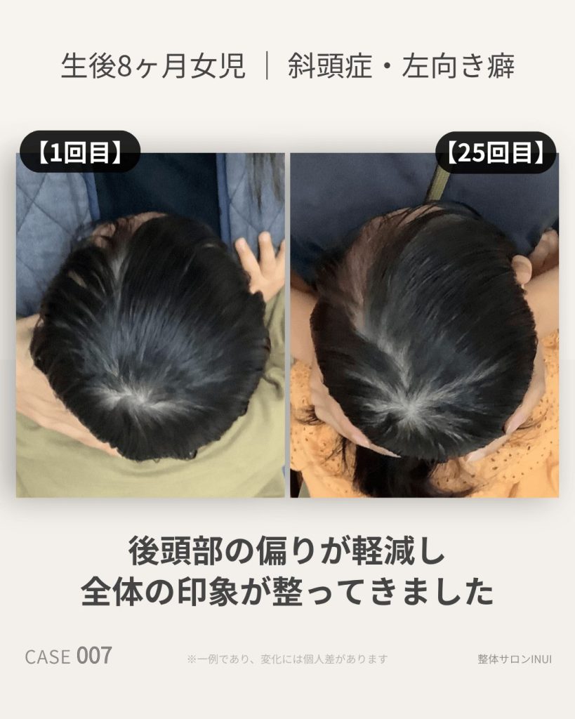 生後8ヶ月女児の斜頭症ビフォーアフター比較