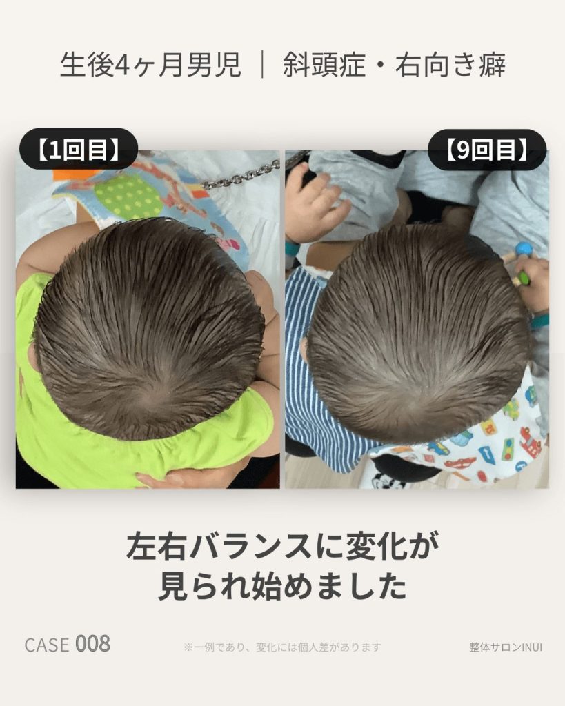 生後4ヶ月男児の斜頭症ビフォーアフター比較