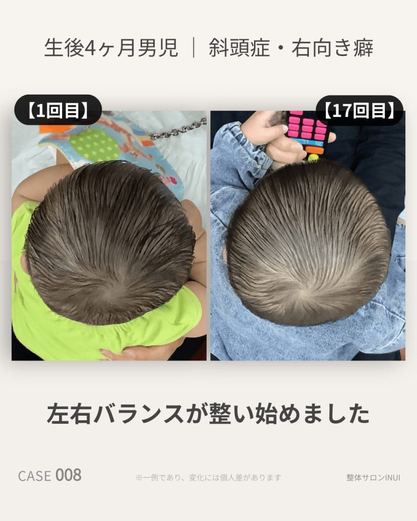生後4ヶ月男児の斜頭症ビフォーアフター比較
