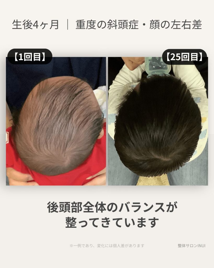 生後4ヶ月男児の斜頭症ビフォーアフター比較